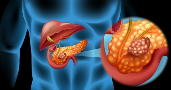 tripla_terapie_care_a_reuit_s_elimine_cancerul_pancreatic_n_teste_pe_animale